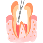 虫歯　C3