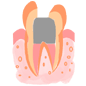 虫歯　C3